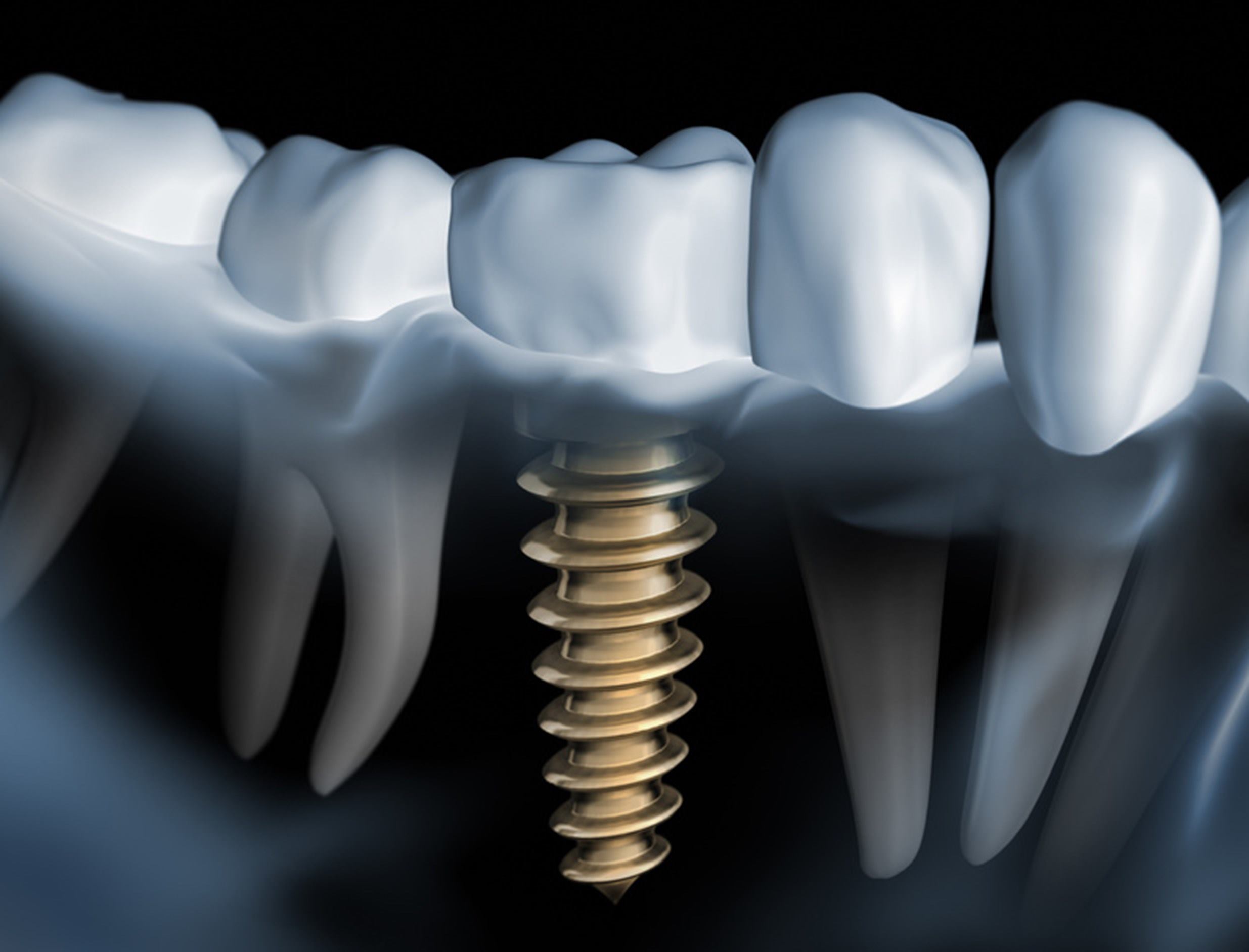 radiografia-boca-dientes-raiz-implante-dental-tornillo